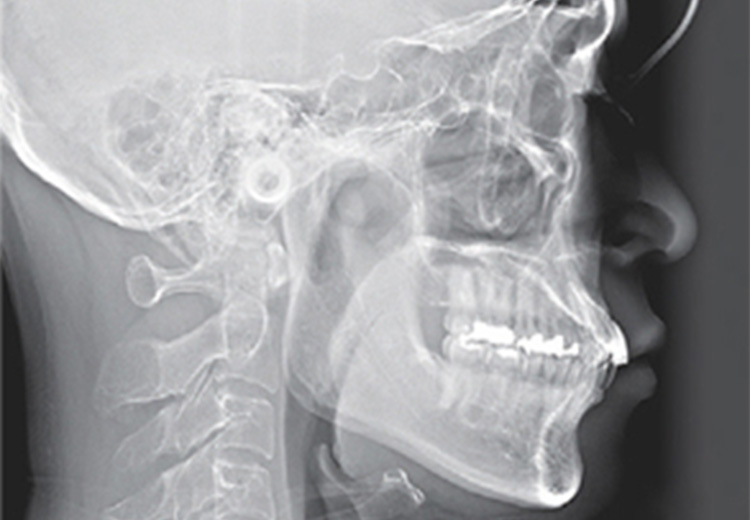 セファロの写真