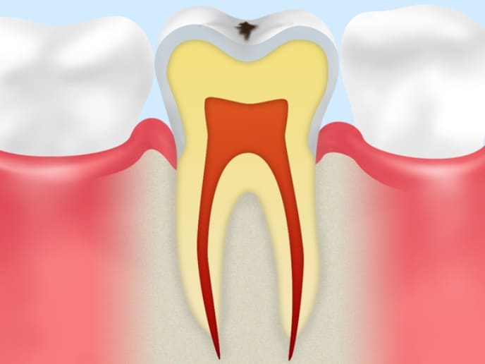 CO：初期のむし歯
