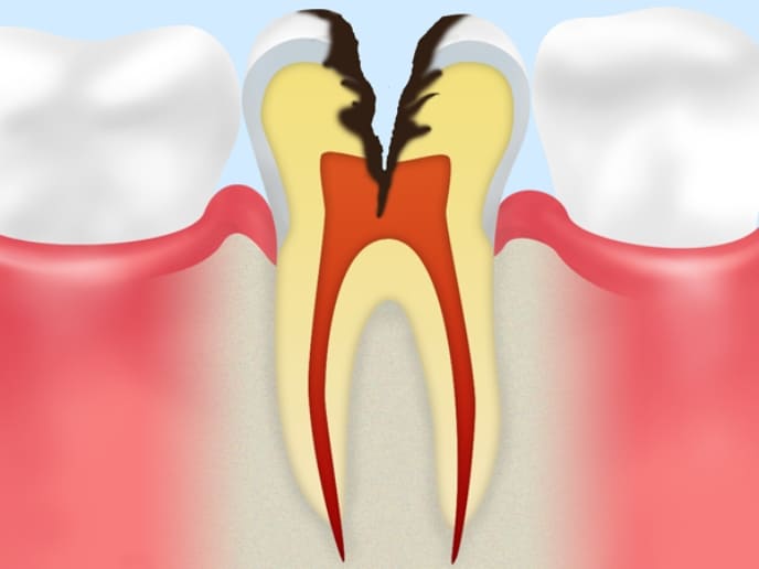 C3：神経に達したむし歯