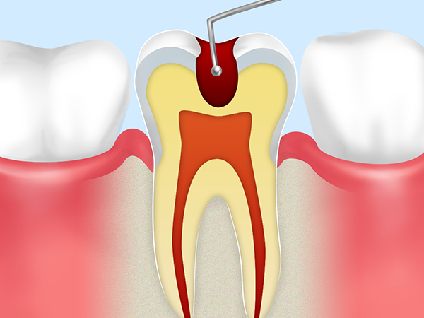 歯をほとんど削らずに虫歯治療できる、カリソルブ導入しました。