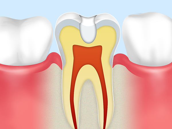 歯をほとんど削らずに虫歯治療できる、カリソルブ導入しました。