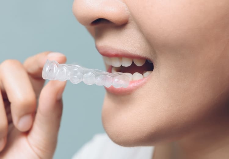 マウスピース矯正を装着｜あお歯科クリニックのマウスピース矯正は日本矯正歯科学会認定医が行います